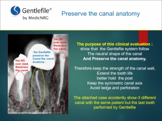 Preserve the canal anatomy