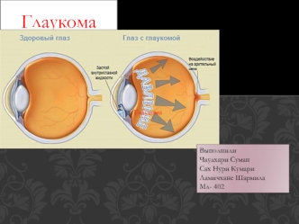 Глаукома. Классификация, лечение