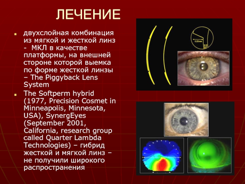 Лечение кератоконуса. Кератоконус классификация Амслера. Кератоконус презентация.