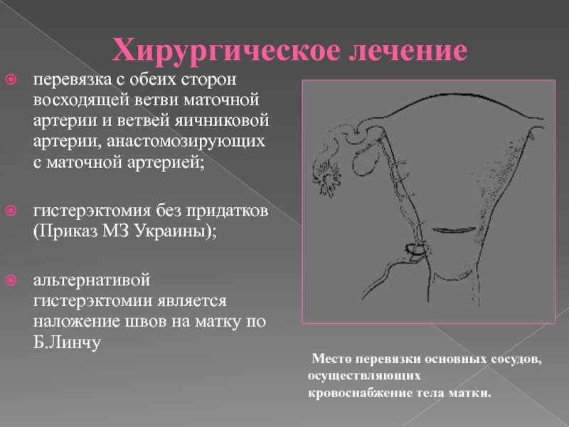 Перевязка маточных сосудов