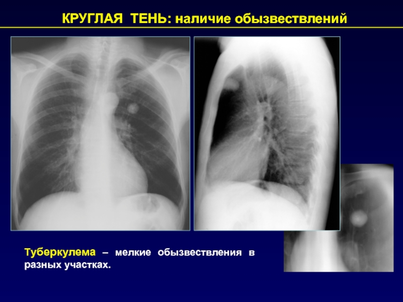 Тень в легких. Кольцевидная тень туберкулема. Синдром круглой тени на рентгенограмме. Округлые тени в легких.