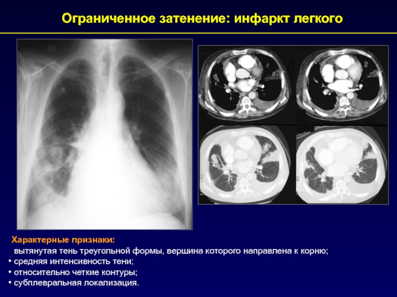 Инфаркт легкого