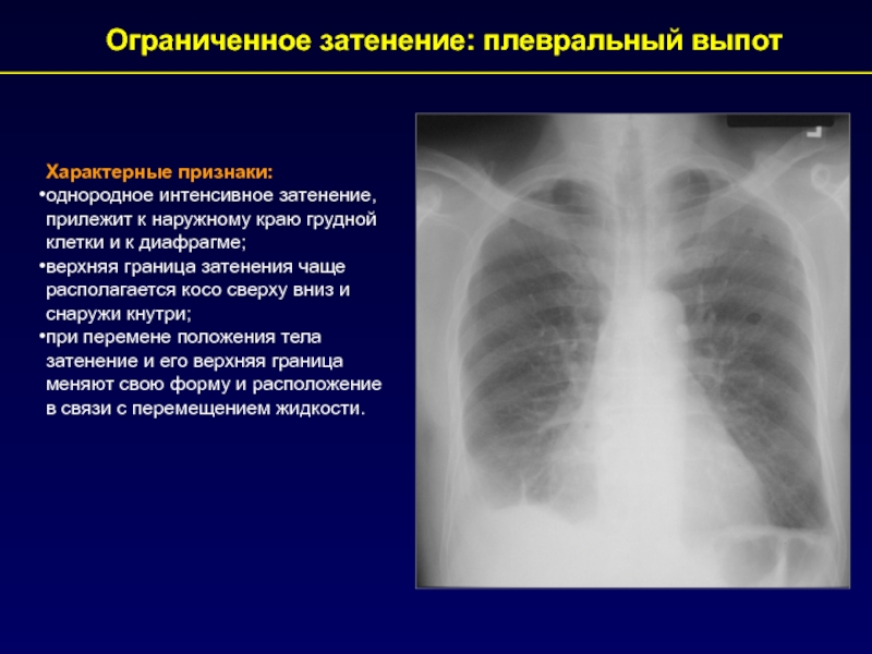 Рентгенологические синдромы легких