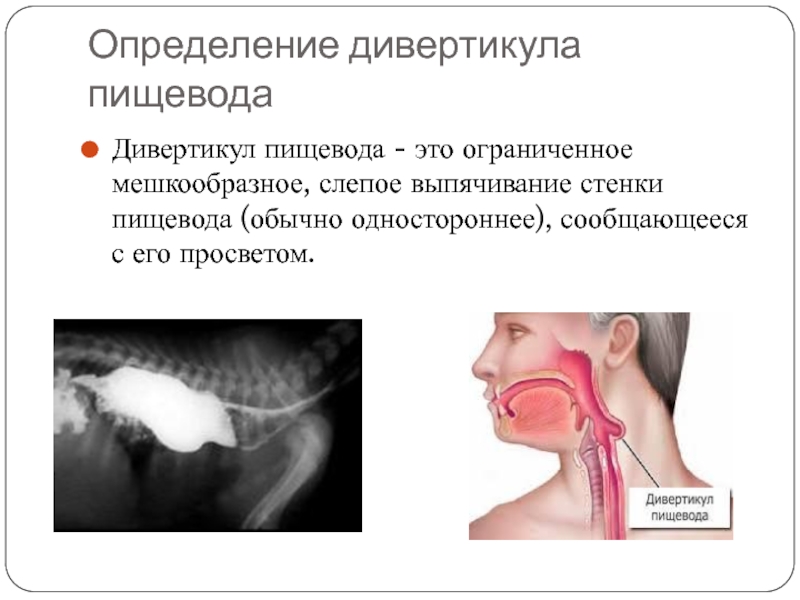 Дивертикул меккеля у детей презентация