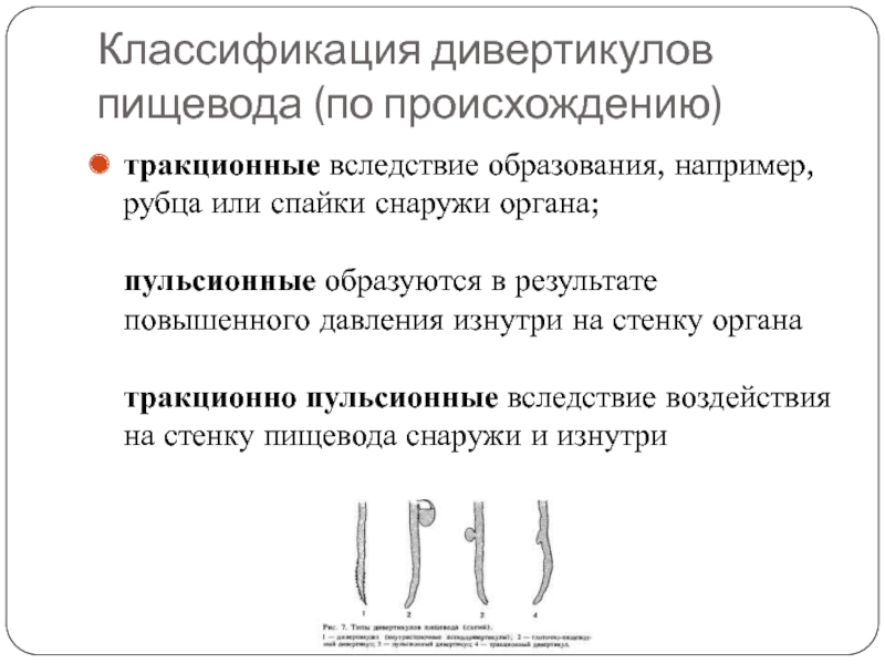 Дивертикул пищевода