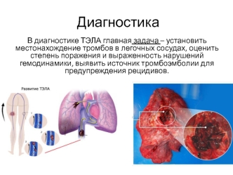 Диагностика ТЭЛА