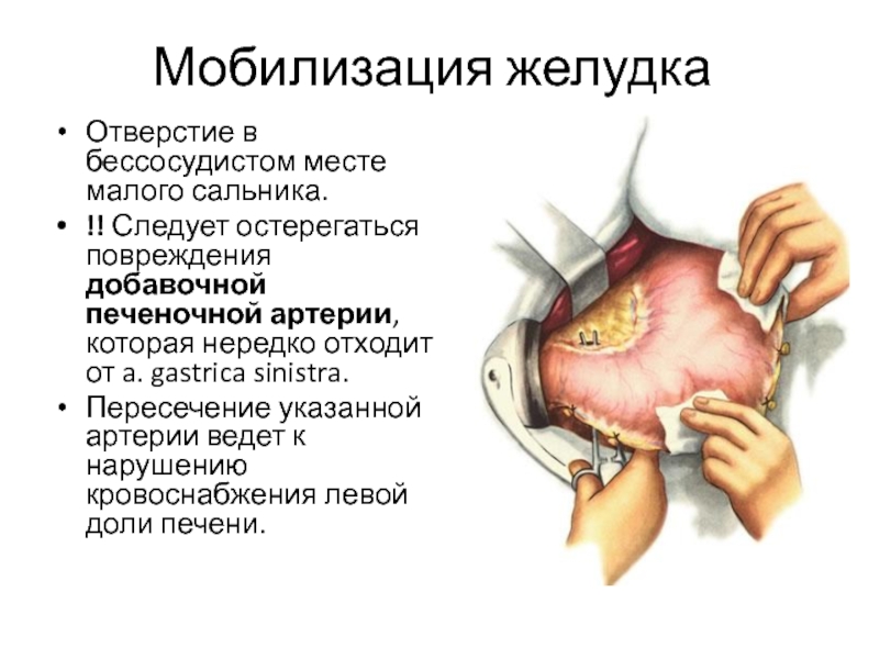 Малый сальник. Печеночно-желудочная связка и малый сальник. Структуры, образующие малый сальник.