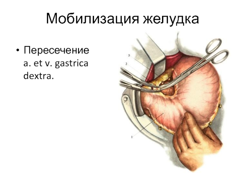 Бильрот 1 и 2 отличия схема