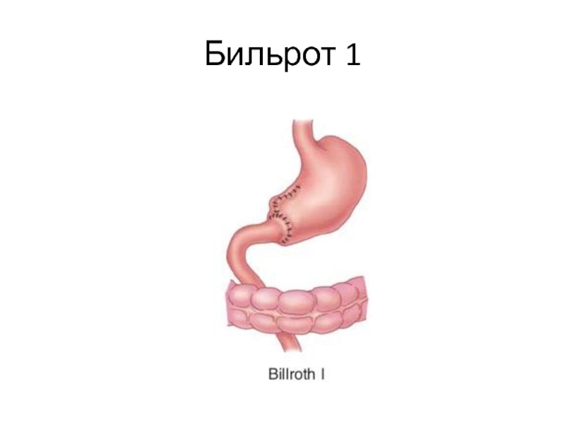 Бильрот 1 и 2 схема кратко