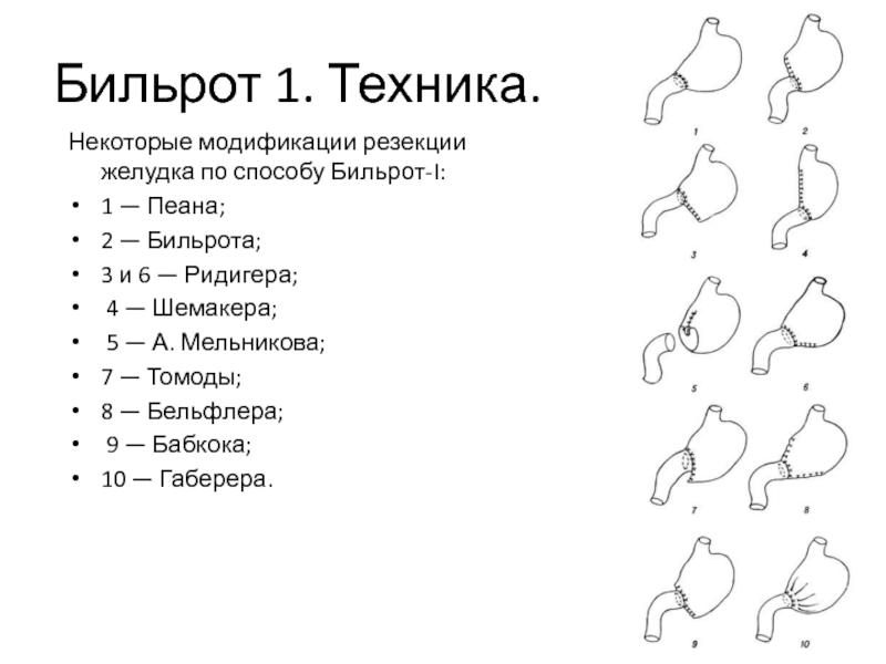 Бильрот 1 и бильрот 2 схема