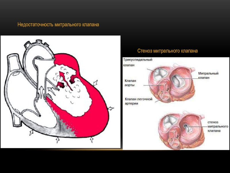 Недостаточность митрального клапана картинка