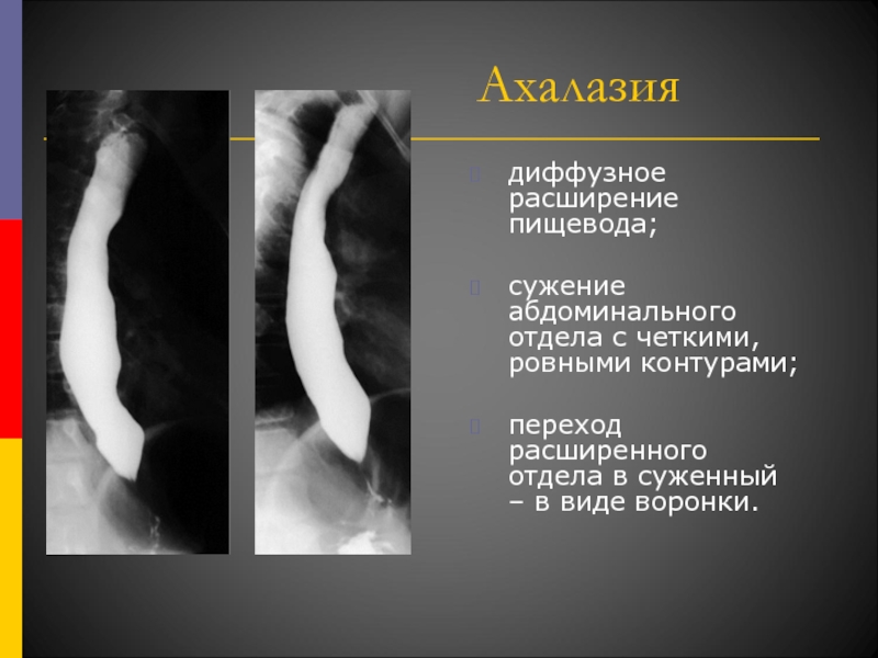 Ахалазия кардии презентация