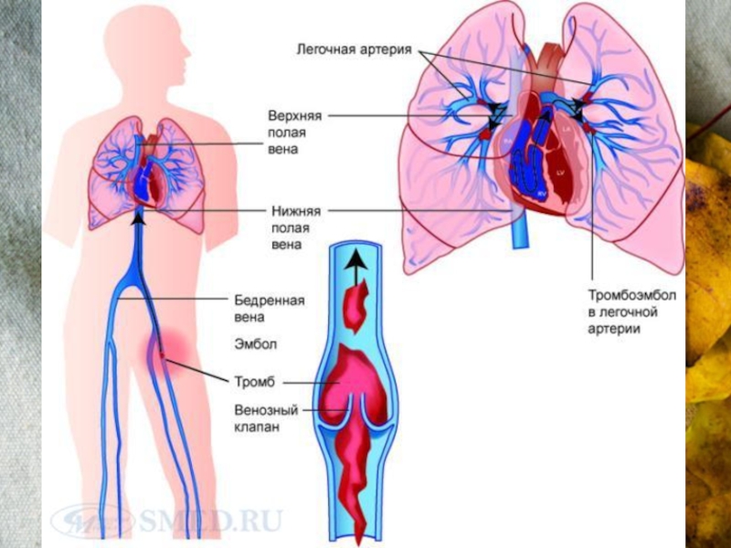 Легочная артерия на рисунке