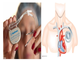 Жүрек кардиостимуляторы