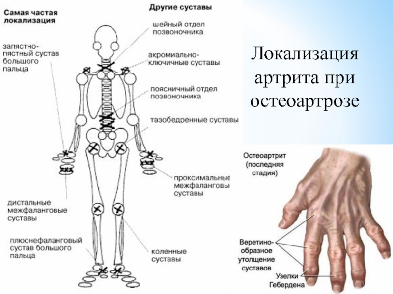 Суставы значит. Суставы человека. Схема суставов человека. Суставы скелета. Локализация остеоартроза.