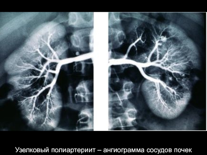 Узелковый полиартериит презентация