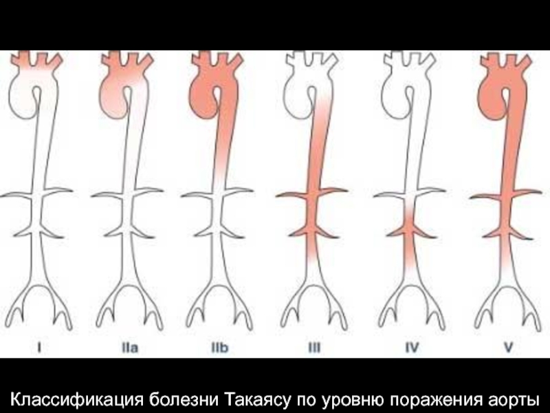 Артериит такаясу презентация