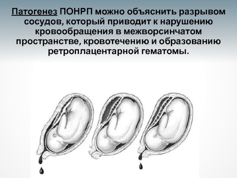 Отслойка на ранних сроках. Преждевременная отслойка плаценты УЗИ. Тотальная отслойка плаценты. Центральная отслойка плаценты. Щелевидная отслойка плаценты.