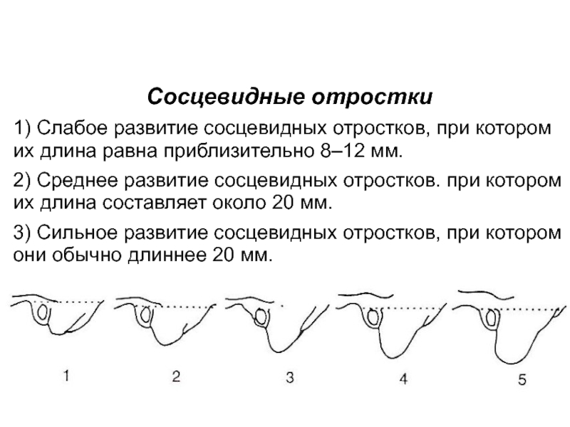 Примерно 8. Пневматический Тип строения сосцевидного отростка. Типы сосцевидных отростков. Развитие сосцевидного отростка. Типы пневматизации сосцевидного отростка.