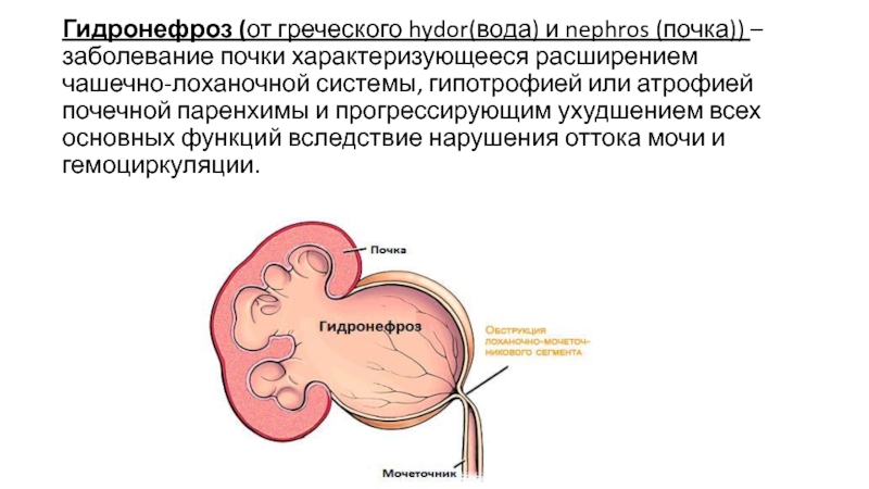 Гидронефроз почки у ребенка