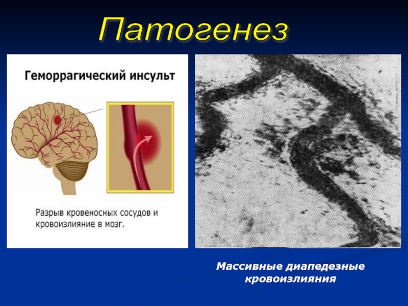 Геморрагический инсульт картинки