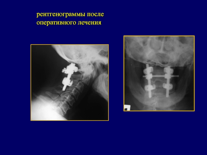 Состояние после оперативного лечения код. Рентгенологический снимок после металлоостеосинтеза.