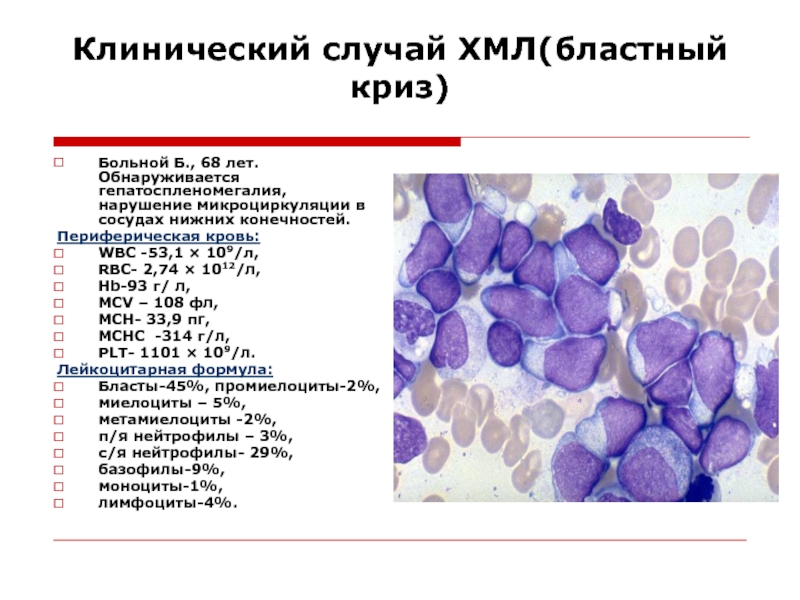 Хр миелолейкоз картина крови