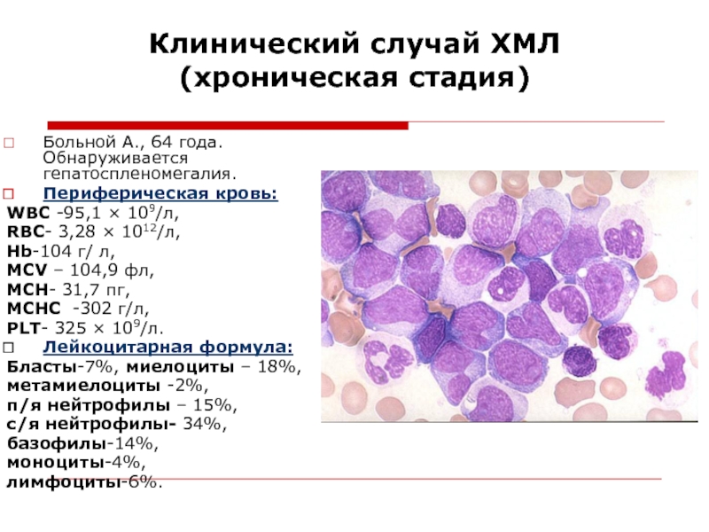 Хр миелолейкоз картина крови