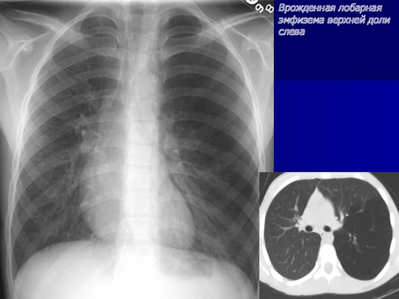 Врожденная лобарная эмфизема клиника рентгенологическая картина принципы лечения