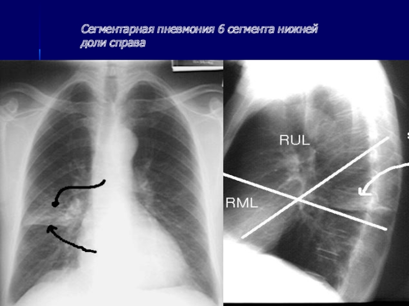 10 легких. Пневмония правосторонняя s4 s5 сегментарная. Очаговая сегментарная долевая пневмония. Пневмония 10 сегмента.