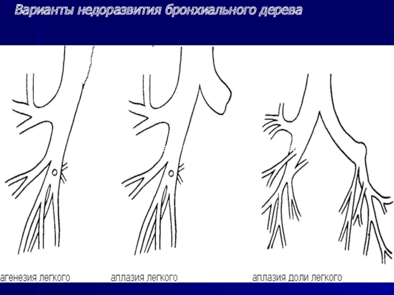 Агенезия венозного. Аномалии развития бронхиального дерева. Аномалии развития бронхов на кт. Аномалии бронхиального и легочного древа. Врожденная аномалия бронхов кт.