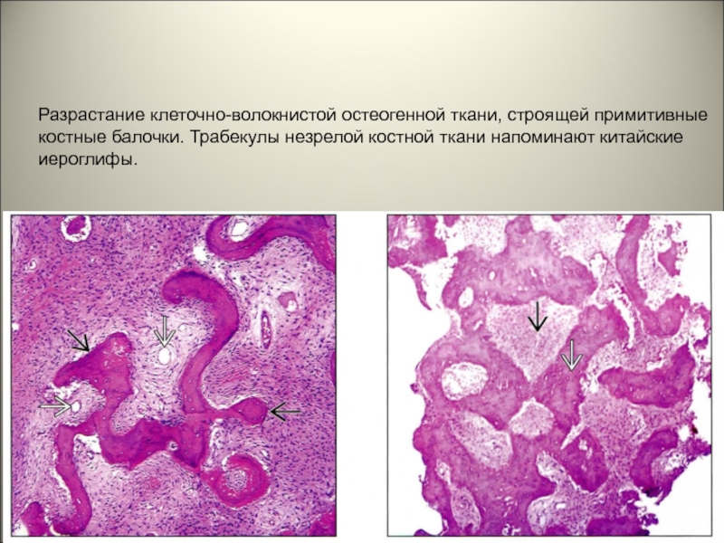Разрастание ткани. Трабекулы костной ткани. Костные трабекулы гистология. Трабекулы кости гистология.
