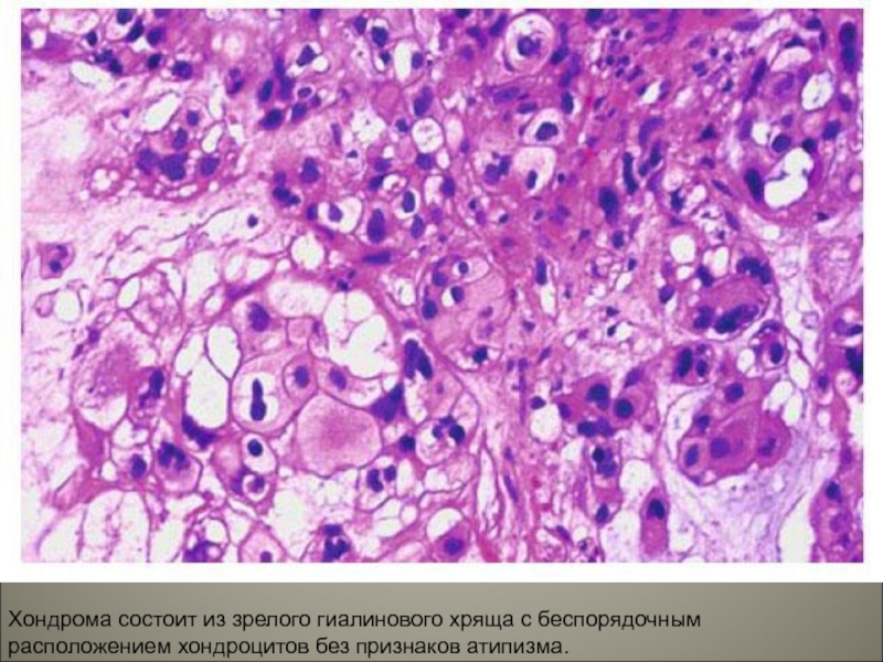 Хондрома микропрепарат рисунок