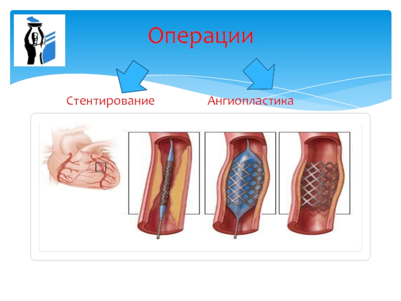 Операция стентирование