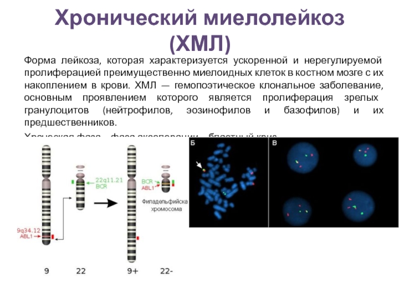 Лейкоз гемограмма