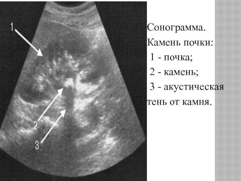 Узи картина мочекаменной болезни