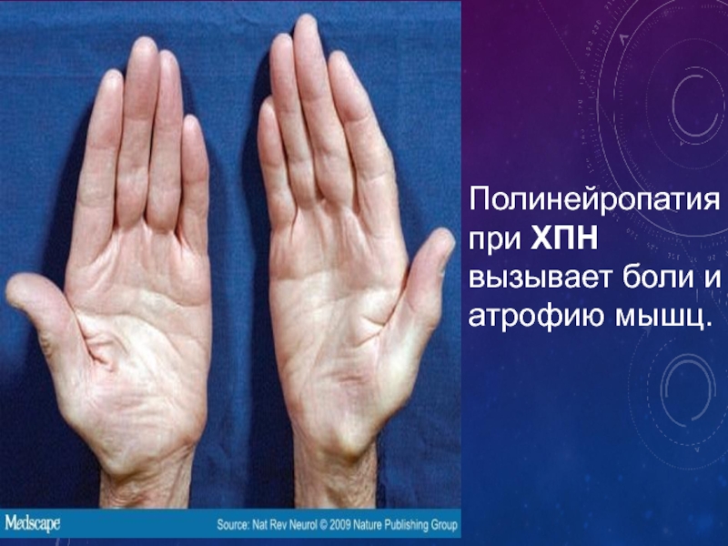 Полинейропатия руки фото