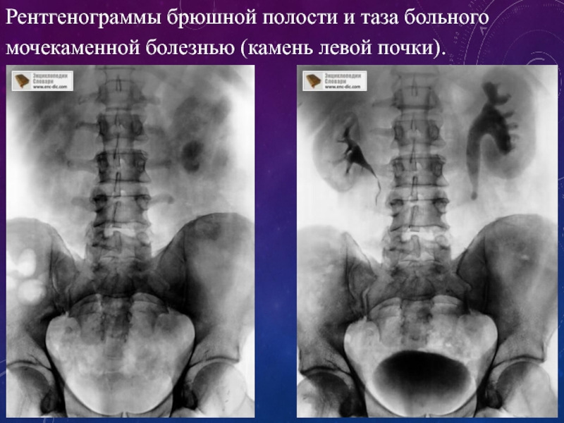 Брюшная полость таза. Рентгенодиагностика мочекаменной болезни. Перфорация рентген брюшной полости. Горизонтальная рентгенограмма брюшной полости. Лучевые симптомы мочекаменной болезни.