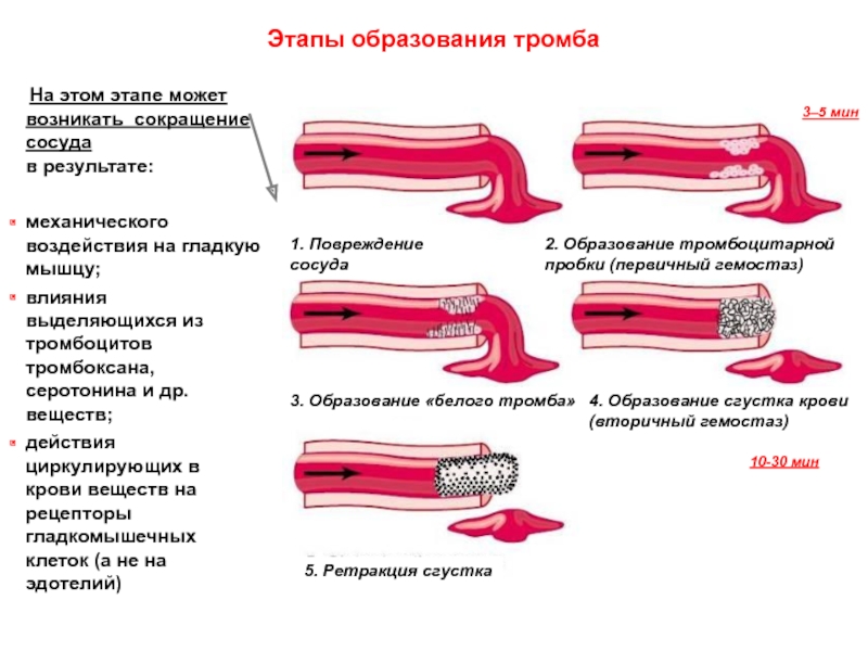 Схема образования сгустка в просвете сосуда