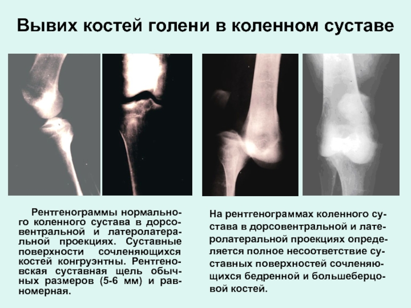 Суставная щель голеностопного сустава. Рентгенография большеберцовой кости. Нормальная рентгенограмма костей голени. Протокол рентгена коленного сустава. Рентгеновская суставная щель коленного сустава.