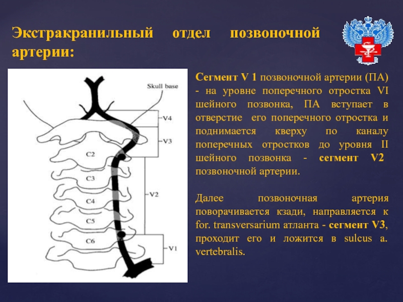 Сегменты позвоночных артерий схема