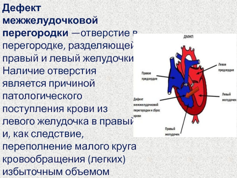 Дефект межжелудочковой перегородки гемодинамика схема