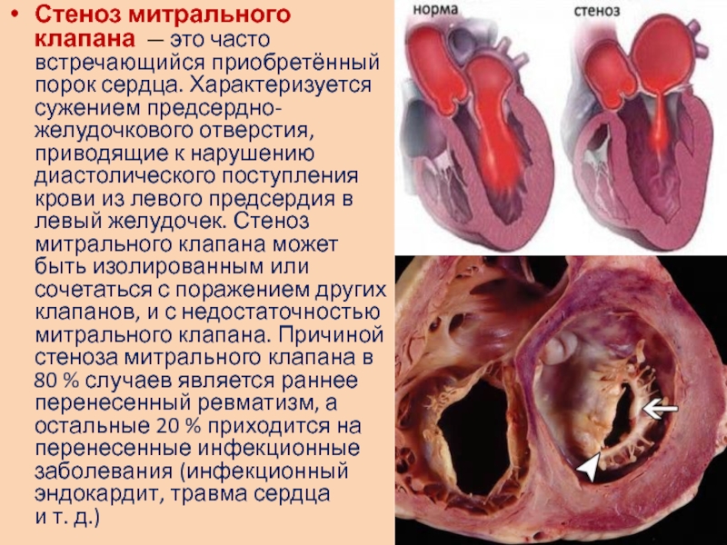 Сочетанный порок митрального клапана