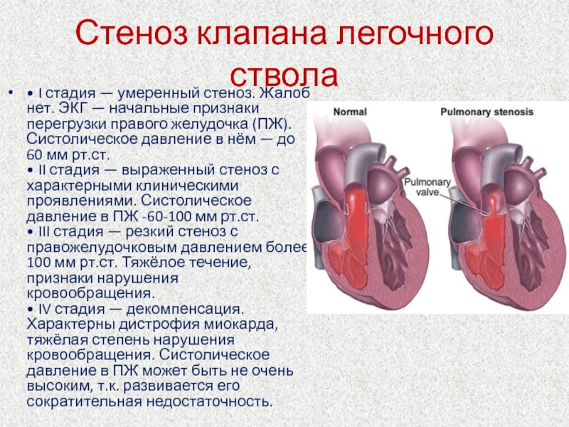 Стеноз артериального клапана сердца