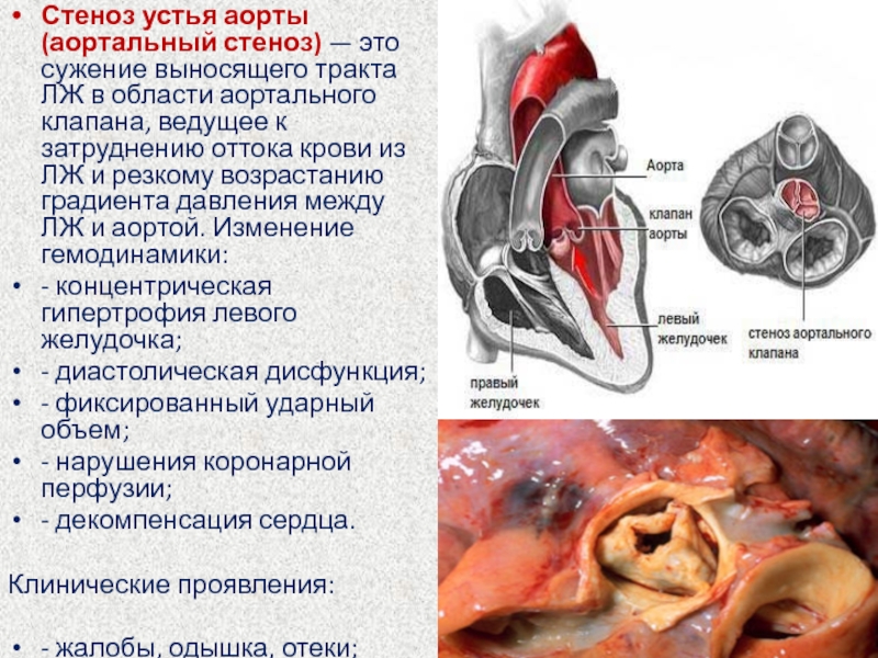 Легочный и аортальный клапан