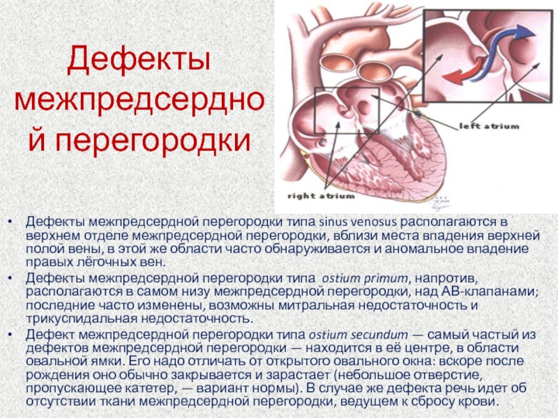 Дефект межпредсердной перегородки