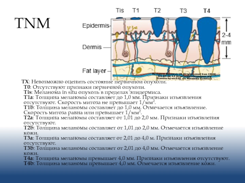 Меланома классификация тнм стадия