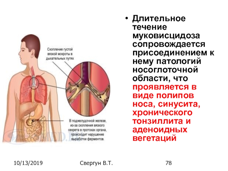 Муковисцидоз целиакию. Течение муковисцидоза. Полипы в носу и муковисцидоз. Полипы при муковисцидозе.