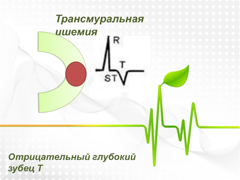 Трансмуральный инфаркт миокарда