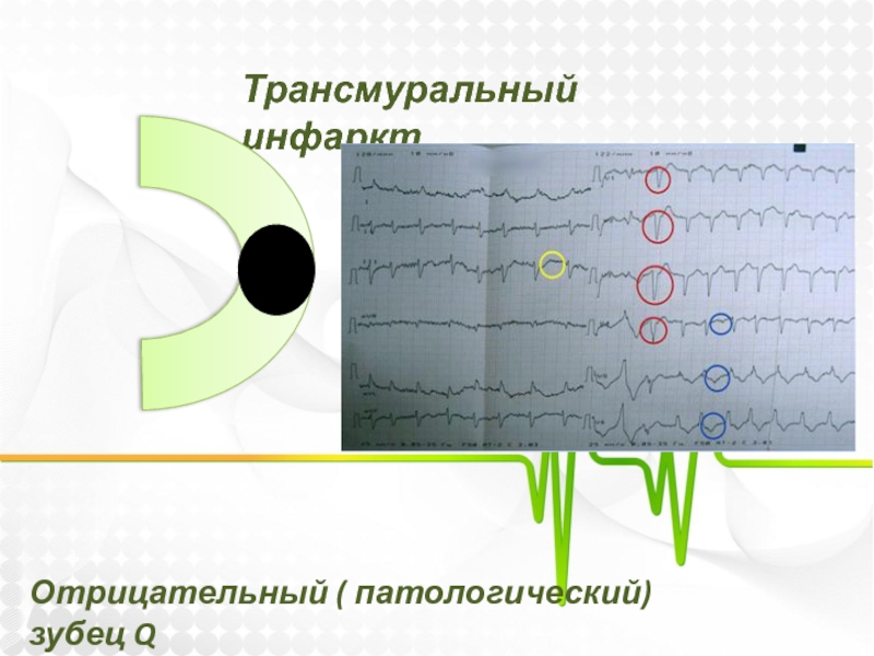 Признаки трансмурального инфаркта